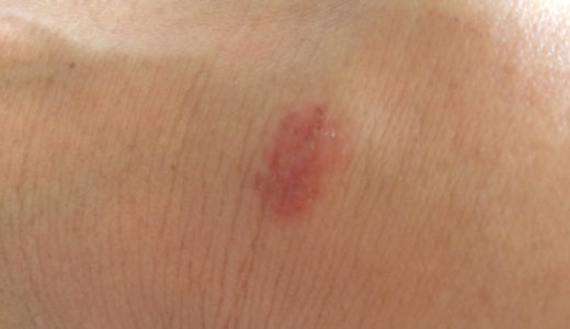 乾癬　再発？